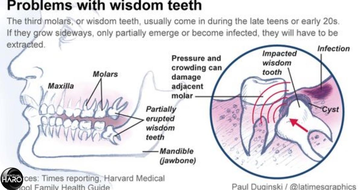 Wisdom Teeth and Inner Wisdom